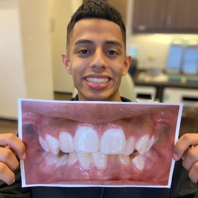 Teen Holding Braces Before & After 2